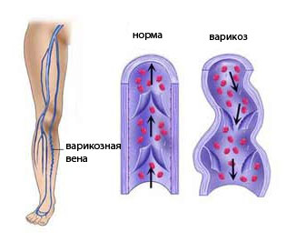 Варикоз на ногах лечение в клинике thumbnail