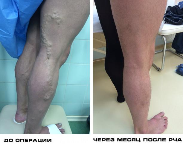 Scleroza venelor picioarelor, Varicoza i scleroza recenzii